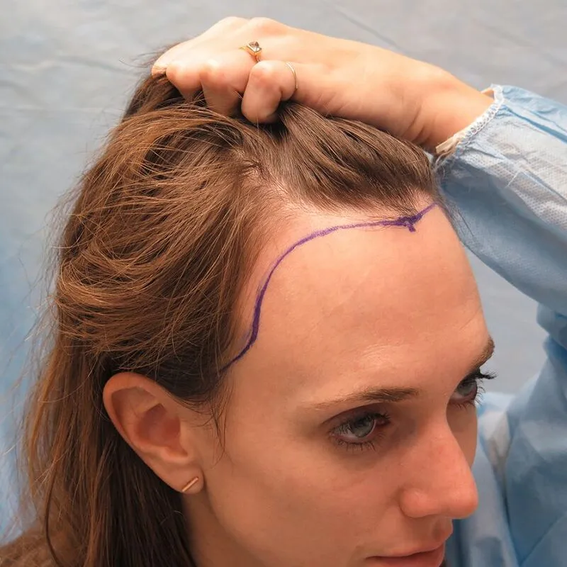 female-hair-transplant